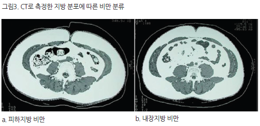침묵의 암살자 뱃속의 시한폭탄 내장지방의 위험성 | 인스티즈