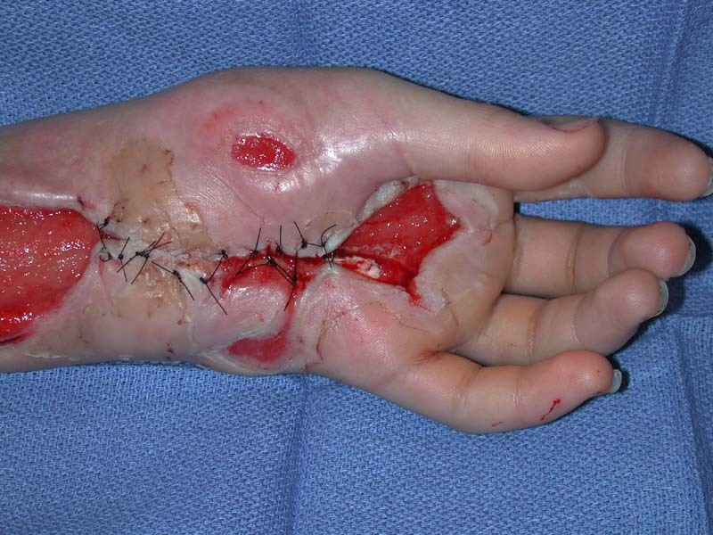 혐오))적나라함 주의)) 방울뱀에게 물린 사람의 치료과정 | 인스티즈