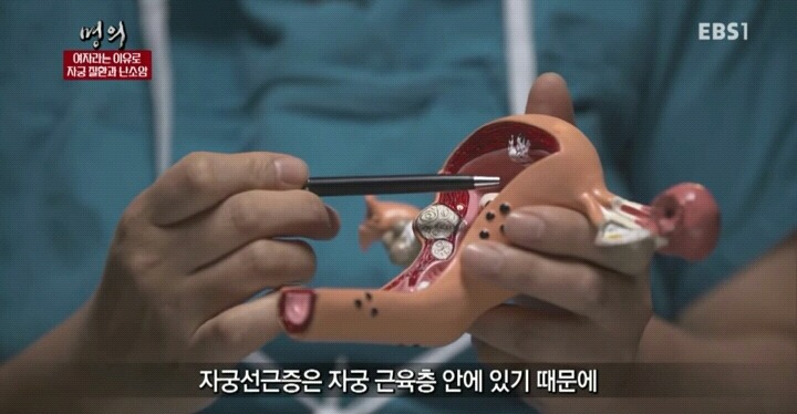 자궁내막조직이 자궁밖에 존재하는 자궁내막증.jpg | 인스티즈