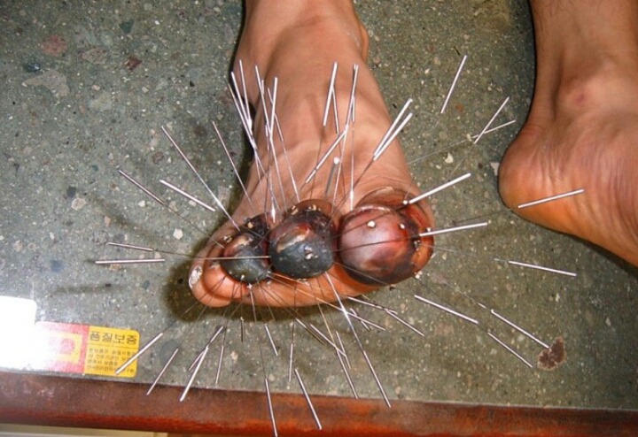 혐)주작 말 나오던 동상환자 침 치료 후기..jpg | 인스티즈