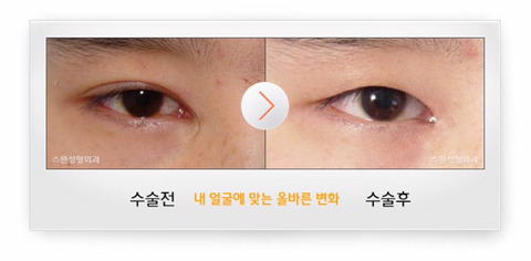 남자 쌍꺼풀 제거 수술 | 인스티즈