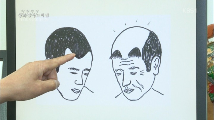 모발이식수술의 이면 | 인스티즈